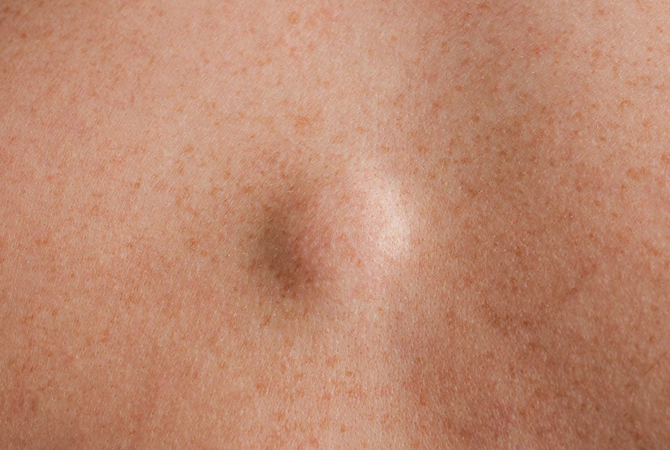 লাইপোমার উপসর্গ ও চিকিৎসা