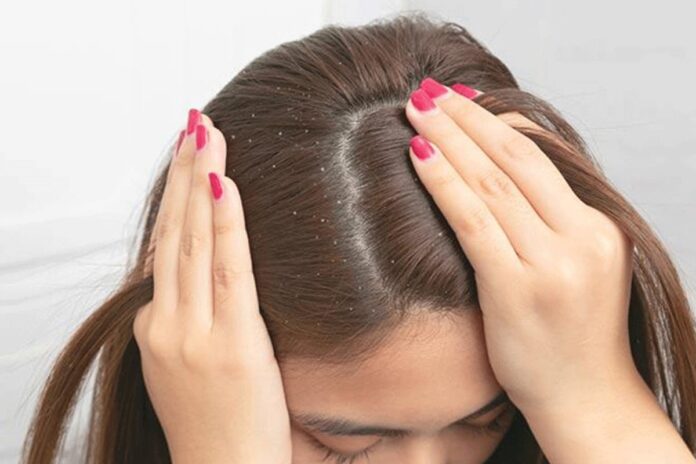 খুশকিমুক্ত চুল পেতে চাইলে