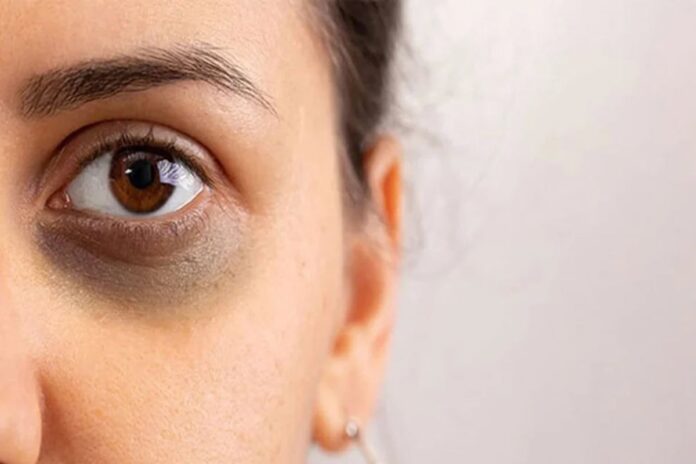 চোখের নিচে কালো দাগ!