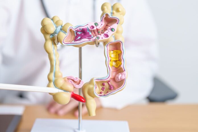 কলোরেক্টাল ক্যান্সার প্রতিরোধযোগ্য : চাই সঠিক সময়ে চিকিৎসা