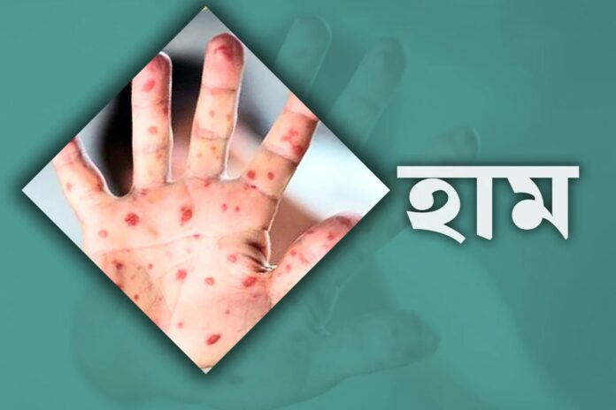 ২৪ ঘণ্টায় হাম ও উপসর্গে ৩ জনের মৃত্যু