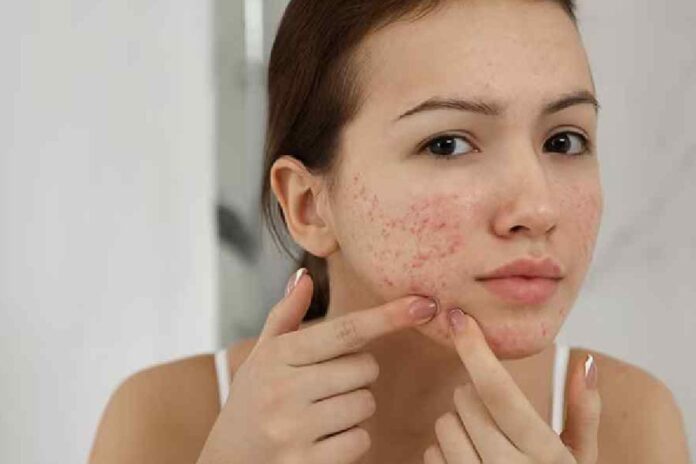 মুখে ব্রণ হচ্ছে? জেনে নিন সহজ সমাধান
