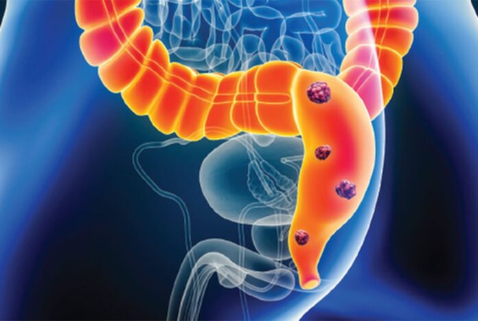 রেক্টাল ক্যান্সারে যে বয়সীদের মৃত্যুর হার দ্রুত বাড়ছে