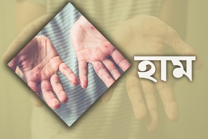 দেশে হামের টিকা পেয়েছে ১ কোটি ৭২ লাখ শিশু