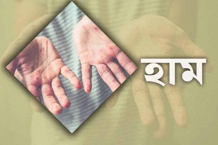 হামে প্রাপ্তবয়স্করাও আক্রান্ত হচ্ছে কেন?
