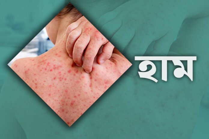 হাম ও উপসর্গে মৃত্যু ৭০০ ছাড়াল